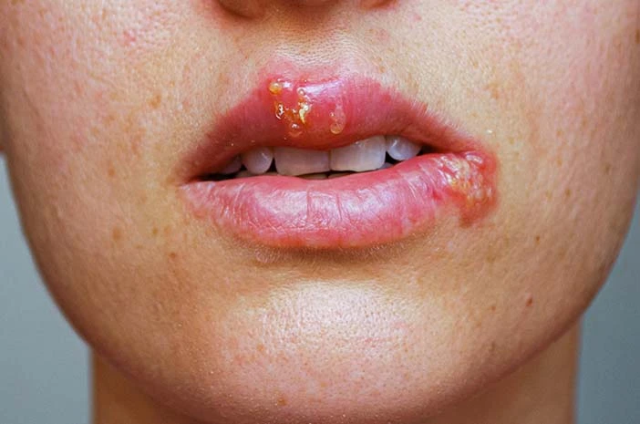 cara mengobati sipilis - cara mengatasi sipilis - cara menyembuhkan sipilis - cara menghilangkan luka sipilis tanpa bekas - obat sipilis paling ampuh - cara mengobati sipilis pada pria dan wanita