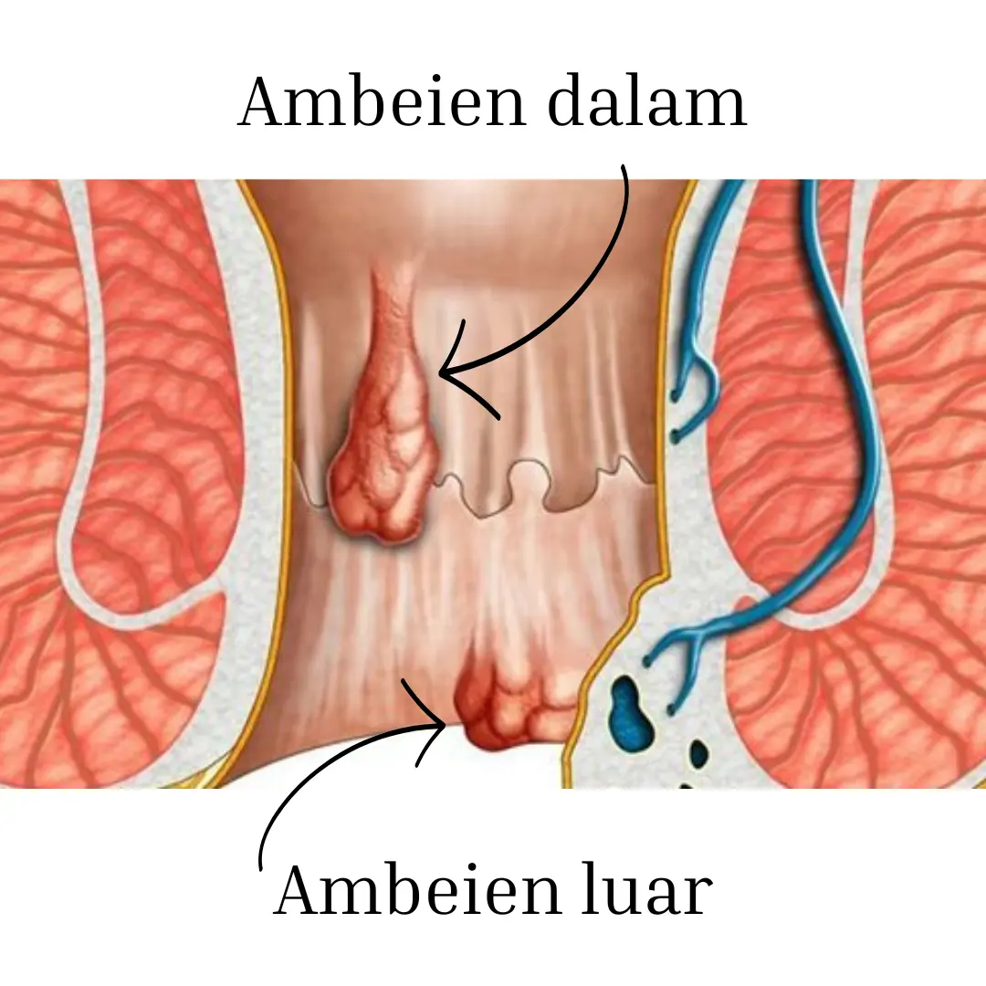 jenis-jenis ambeien - obat ambeien - obat ambeien paling ampuh - obat ambeien ibu hamil - obat ambeien alami - obat ambeien wasir - obat hemorrhoid