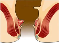 obat ambeien - obat ambeien ampuh - obat ambeien paling ampuh - obat ambeien stadium 1 - obat ambeien untuk ibu hamil - obat ambeien berdarah - obat nyeri ambeien -ambeien stadium 1