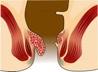 obat ambeien - obat ambeien ampuh - obat ambeien paling ampuh - obat ambeien stadium 2 - obat ambeien untuk ibu hamil - obat ambeien berdarah - obat nyeri ambeien