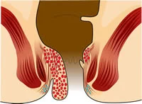 obat ambeien - obat ambeien ampuh - obat ambeien paling ampuh - obat ambeien stadium 3 - obat ambeien untuk ibu hamil - obat ambeien berdarah - obat nyeri ambeien