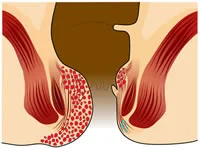 obat ambeien - obat ambeien ampuh - obat ambeien paling ampuh - obat ambeien stadium 4 - obat ambeien untuk ibu hamil - obat ambeien berdarah - obat nyeri ambeien